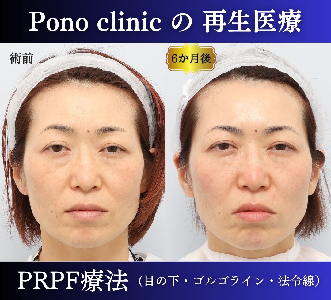 芝容平　PRPF®療法症例 (2)